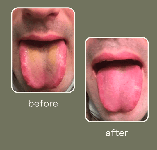 How to Scrape Your Tongue Using a Tongue Scraper?