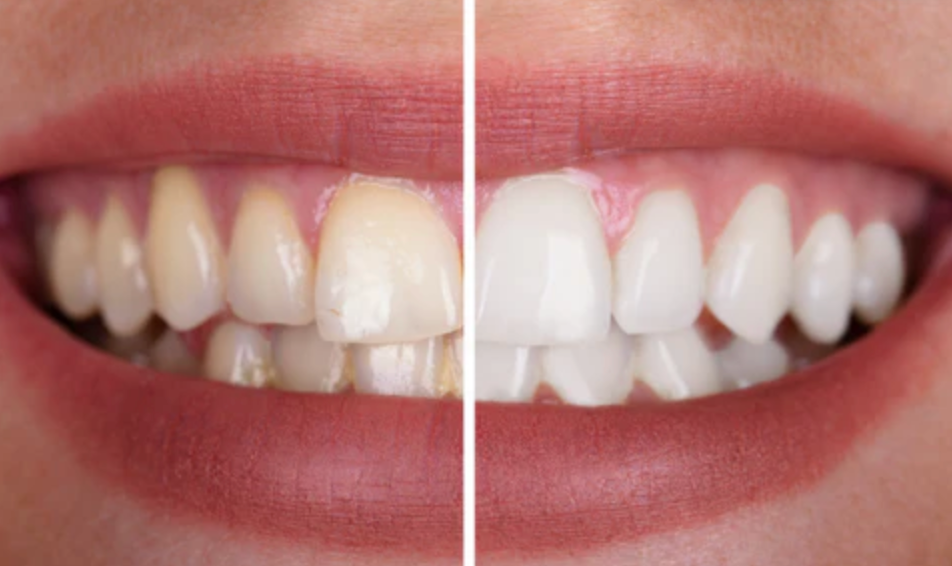 Does Oil Pulling Whiten Teeth?
