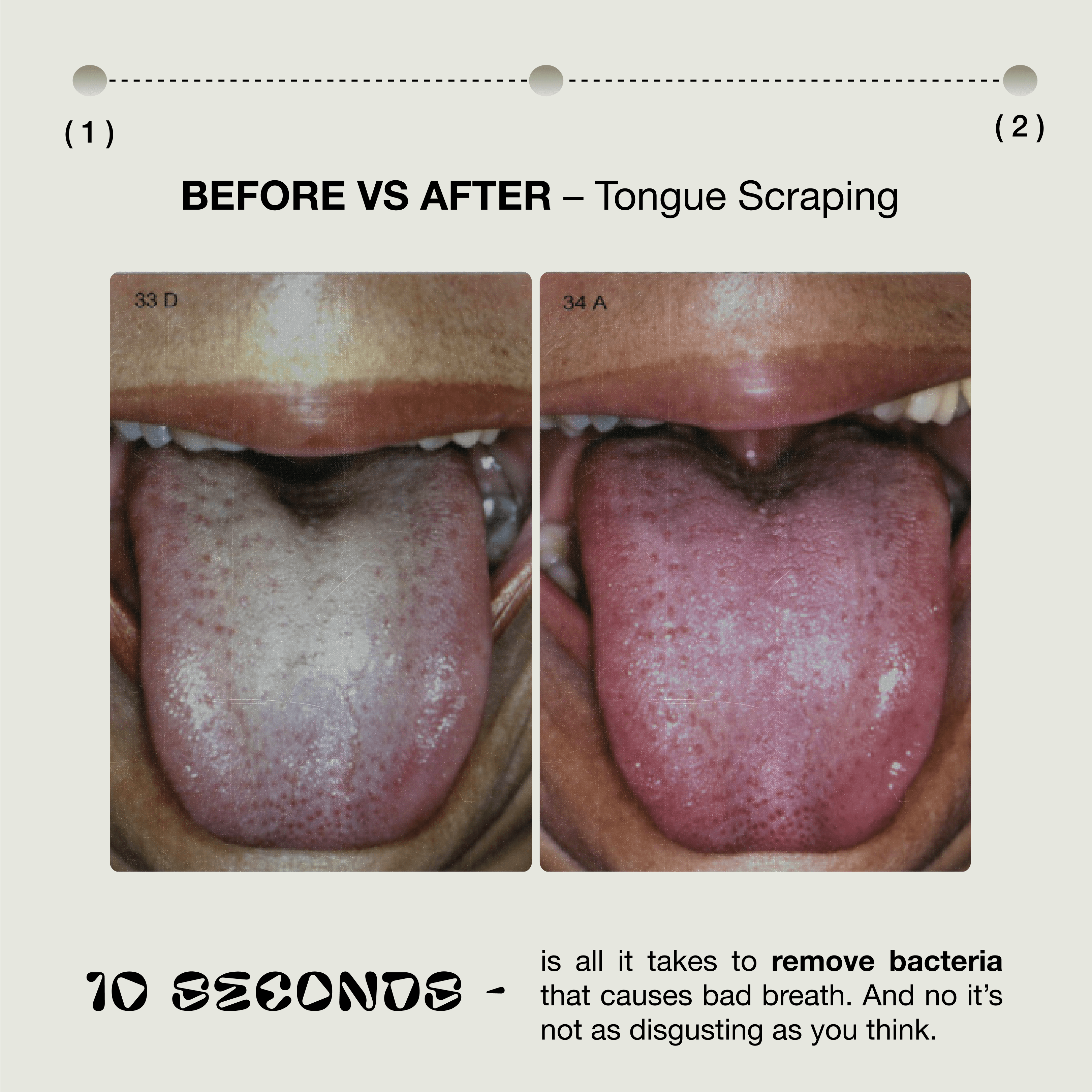 Before and after tongue scraping comparison showing thick whitish coating removed to reveal a clean pink tongue
